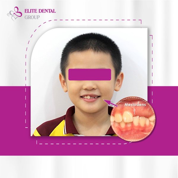Trường hợp răng dị dạng mọc dư bên trong nướu