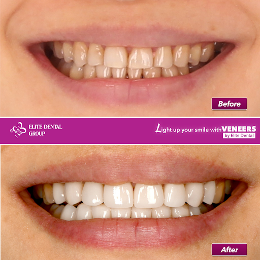 Hàm răng của khách hàng trước và sau khi dán sứ Veneer