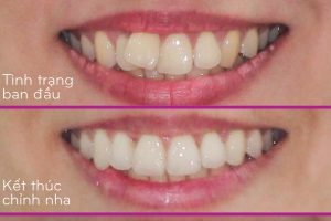 Răng của bệnh nhân trước và sau khi niềng răng