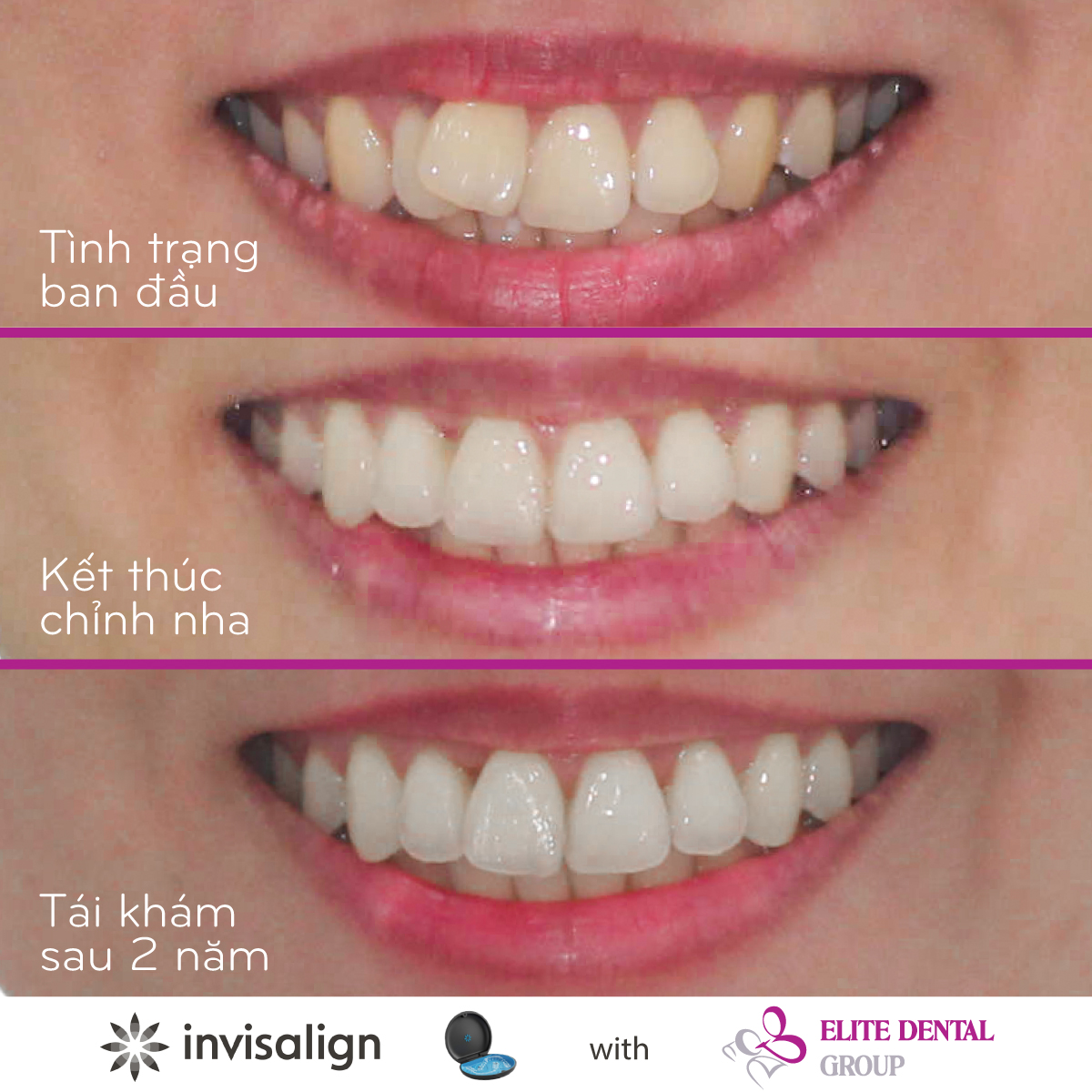 Quá trình răng của bệnh nhân thay đổi sau khi điều trị
