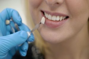 Quy trình dán sứ Veneer hoàn chỉnh tại Elite Dental