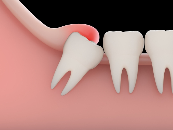 Mọc Răng Khôn Sưng Nướu: Nguyên Nhân, Triệu Chứng và Cách Điều Trị Hiệu Quả