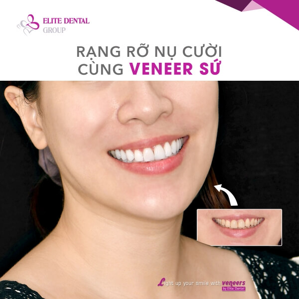 Răng của khách hàng sau khi dán sứ Veneer
