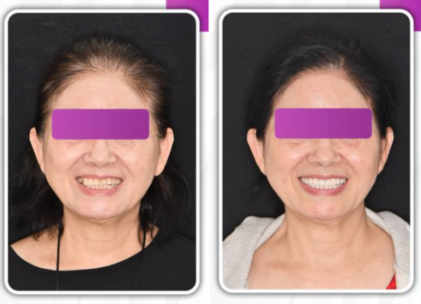 Răng của khách hàng trước và sau khi dán sứ Veneer