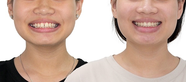 Răng của khách hàng trước và sau khi điều trị