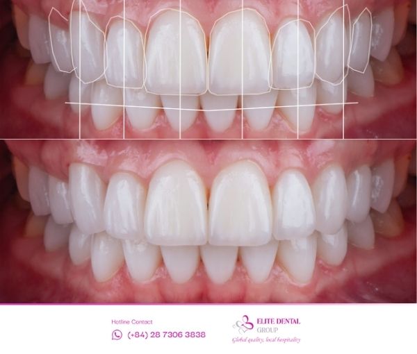 Dựa vào công nghệ Digital Smile Design (DSD) bạn có thể xem được dáng răng của mình sau khi điều trị.