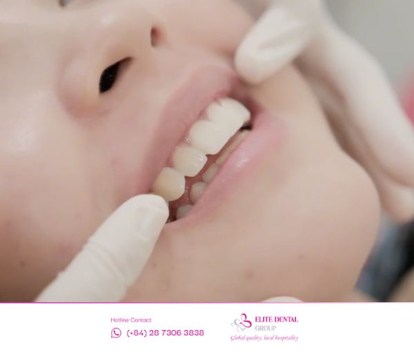 Bác sĩ sẽ cân chỉnh khớp cắn phù hợp cho bạn