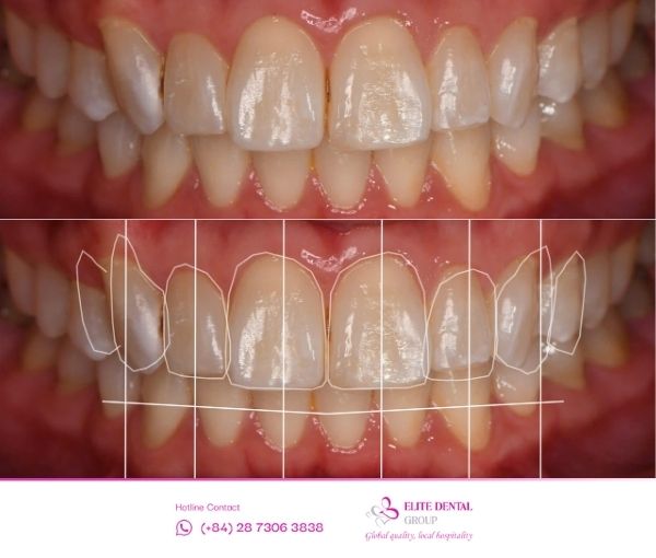 Trước và sau bọc sứ thẩm mỹ