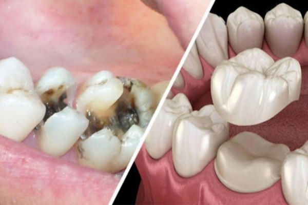 Bọc sứ răng sâu có được không?