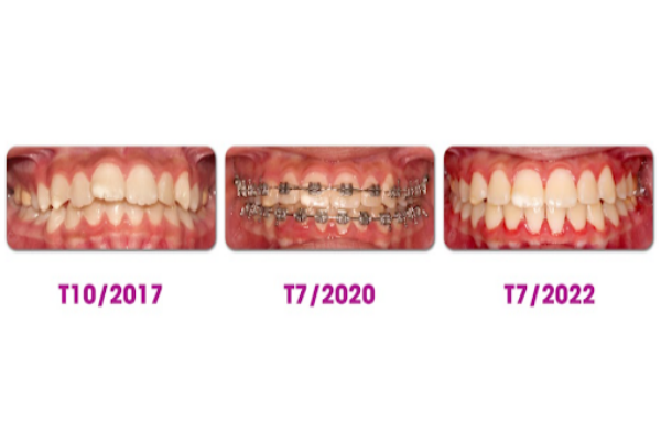 Quá trình răng của khách hàng thay đổi