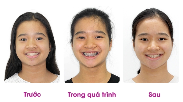 Răng của khách hàng trước và sau khi niềng