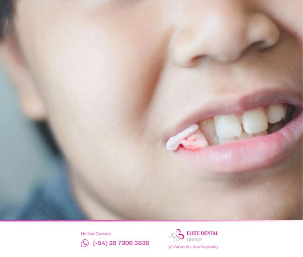 Sau khi nhổ răng khôn bạn cần chú ý chăm sóc sức khoẻ răng miệng và có chế độ ăn hợp lý