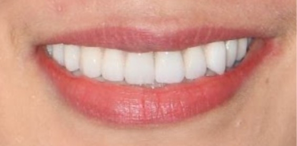 Răng của bệnh nhân sau khi điều trị