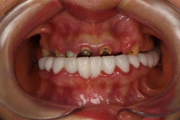 Răng của bệnh nhân trước khi điều trị