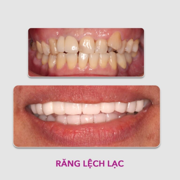 Răng của bệnh nhân trước và sau khi bọc răng sứ