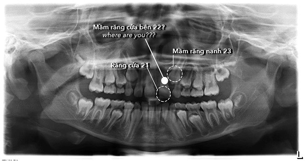 Hình chụp x-quang tình trạng thiếu mầm răng cửa số 22