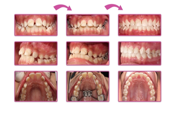 Răng của khách hàng khi hoàn tất điều trị