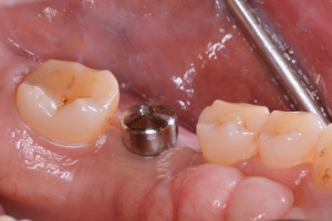 hình ảnh healing abutment được đặt khi cấy trụ implant