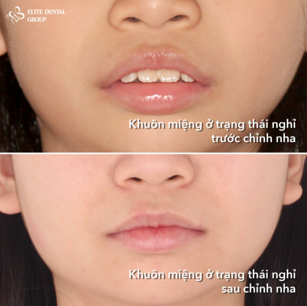 Khuôn miệng của bé trước và sau khi chỉnh nha