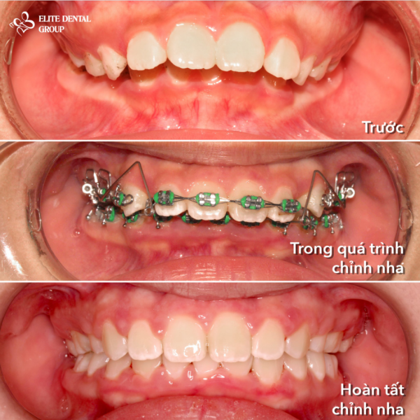 Quá trình hàm răng của bé thay đổi