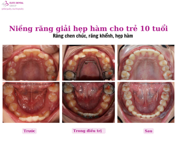 Quá trình răng của trẻ thay đổi khi đeo khí cụ nong hàm