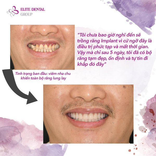 Răng của khách hàng trước và sau