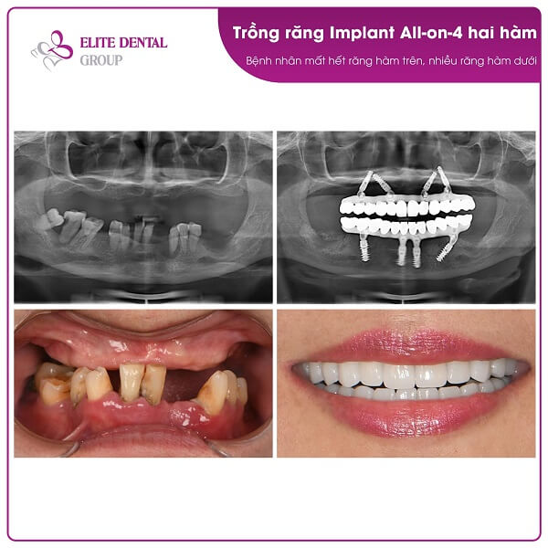 cắm 4 trụ Implant theo kỹ thuật ProArch All-on-4