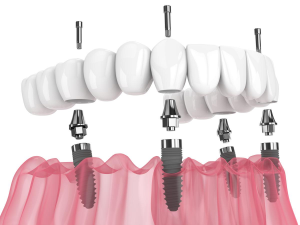 cấy ghép Implant là phương pháp ngăn chặn tiêu xương hàm