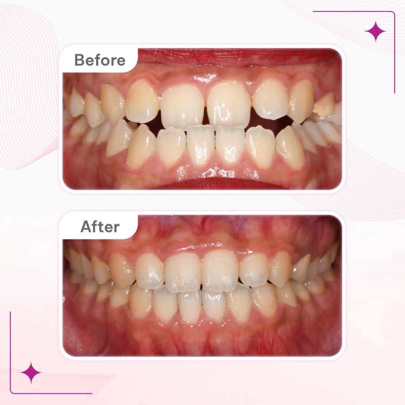 Góc cận răng thẳng trước và sau khi niềng răng