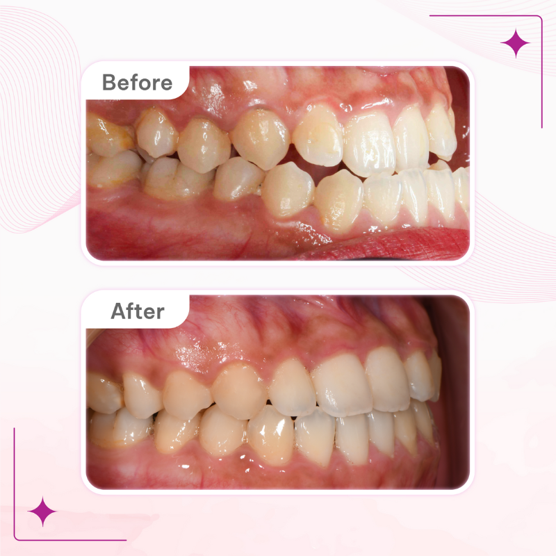 Góc nghiêng cận răng thay đổi rõ rệt sau niềng răng