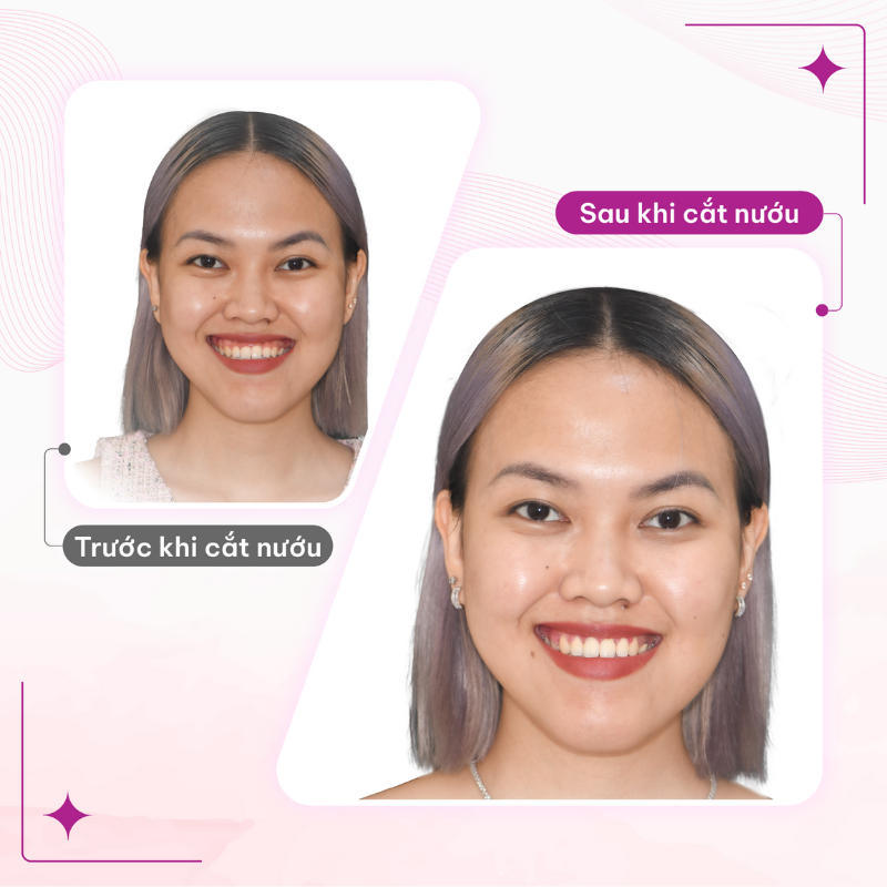 Hành trình niềng răng đã kết thúc rồi, móm đã tạm biệt rồi. Còn hở nướu nhẹ là chuyện nhỏ! Đã có tiểu phẫu cắt nướu lo. Hình ảnh trước và sau khi thực hiện tiểu phẫu cắt nướu, T.N sở hữu nụ cười hoàn chỉnh hơn.