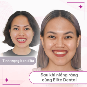 Khuôn miệng duyên dáng và xinh xắn hơn, đường nét khuôn mặt rạng rỡ và bắt mắt hơn là hình ảnh của T.N sau 4 năm đồng hành niềng răng cùng Elite Dental.