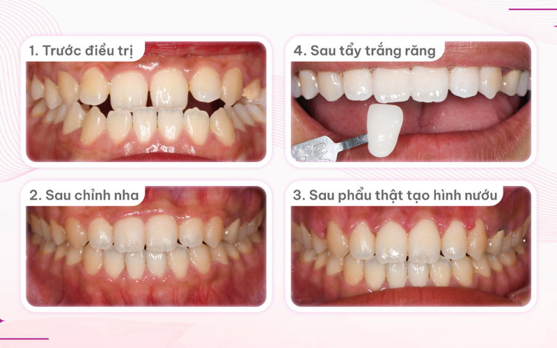Trước và sau khi tẩy trắng răng. Tẩy trắng được thực hiện sau khi T.N đã cắt nướu hoàn tất và ổn định.