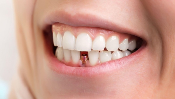 cấy implant khi mất răng số 2