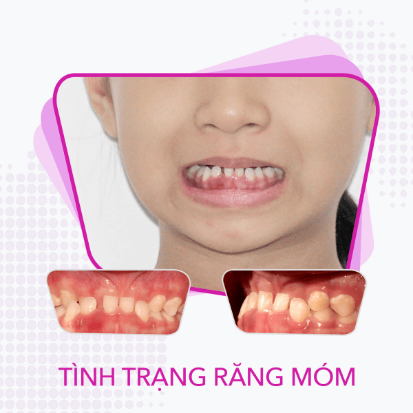 Khớp cắn ngược (hay còn gọi là móm)