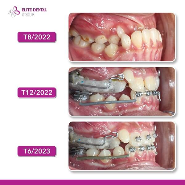 Điều trị khớp cắn ngược.