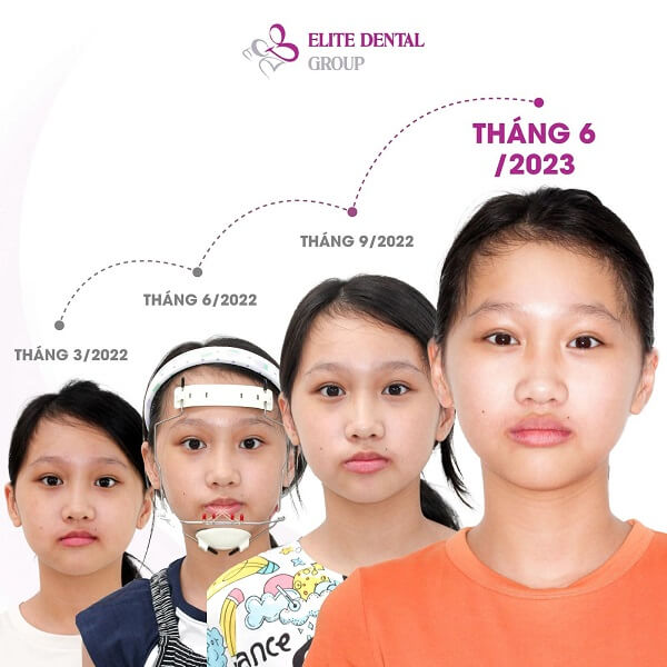 Kết quả sau điều trị khớp cắn ngược.