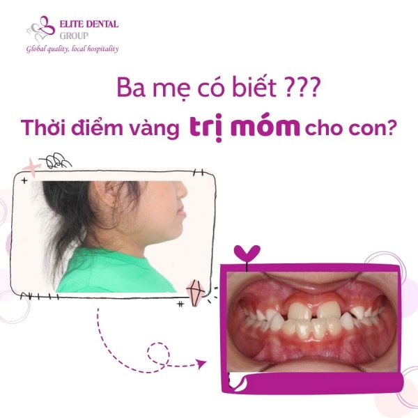 Giai đoạn từ 6-12 tuổi là “cơ hội vàng” vì xương hàm vẫn còn mềm và đang phát triển