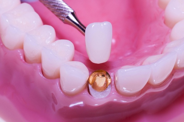 răng hàm bị sâu chỉ còn chân răng