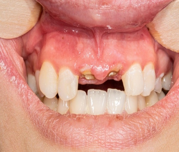 răng sâu bị vỡ chỉ còn chân răng