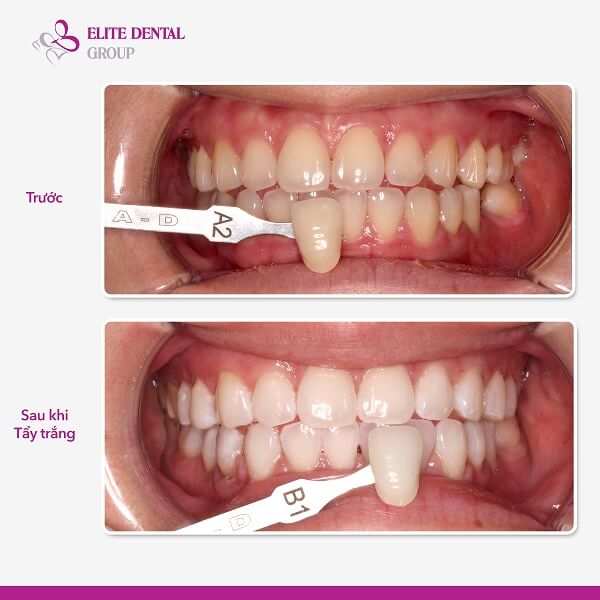 tẩy trắng răng tại Elite Dental