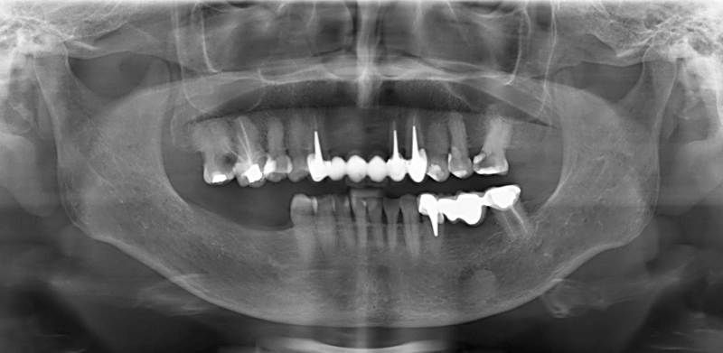 Tình trạng răng ban đầu