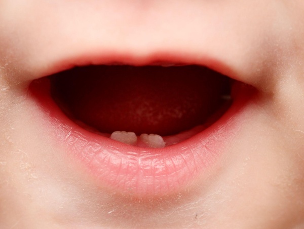 trẻ mọc răng sớm có phải thừa canxi