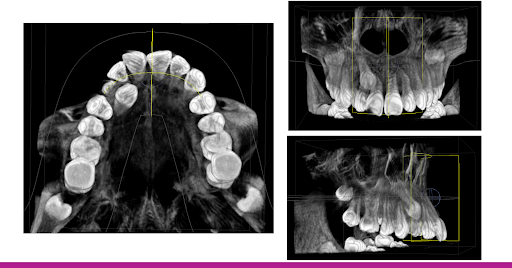 Hình ảnh phim chụp CBCT khảo sát răng nanh ngầm hàm trên