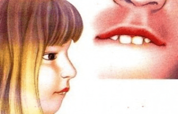 Mút môi ở trẻ em dẫn đến cắn chìa
