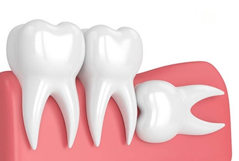 Răng khôn mọc lệch nguy hiểm không? Cách xử lý