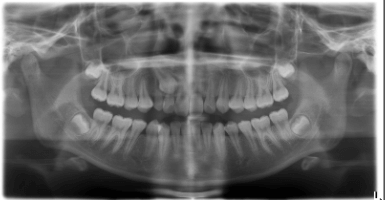 Trong xương hàm có mầm răng nanh vĩnh viễn