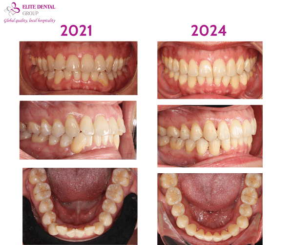 Hành trình niềng răng trong suốt của B.T từ 2021 đến 2024