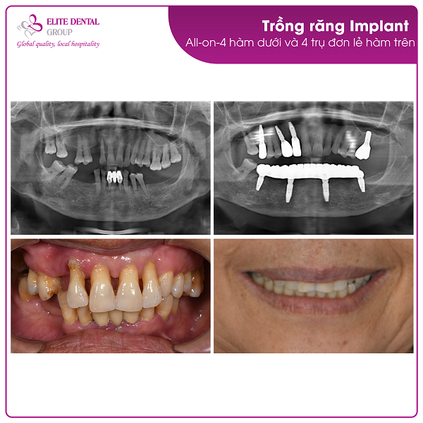 Hình ảnh chụp trước và sau điều trị Implant của cô Nguyễn Thị Vân