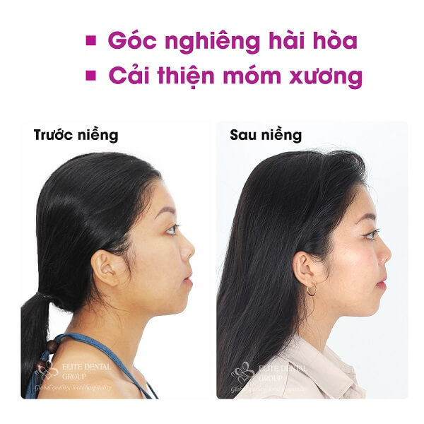 hình ảnh góc nghiêng trước và sau khi niềng răng của Bảo Châu